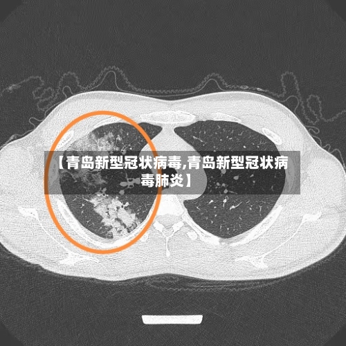 【青岛新型冠状病毒,青岛新型冠状病毒肺炎】-第2张图片