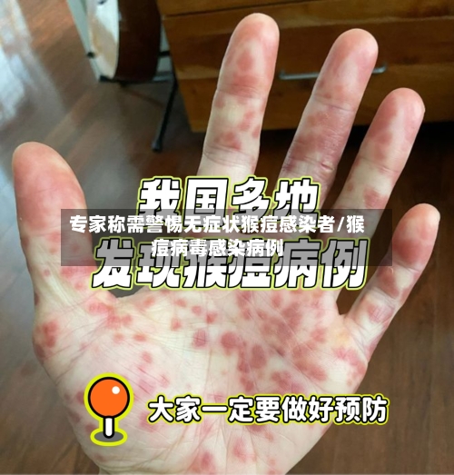 专家称需警惕无症状猴痘感染者/猴痘病毒感染病例-第3张图片
